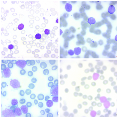 Blood Cancer Cells Thumbnail