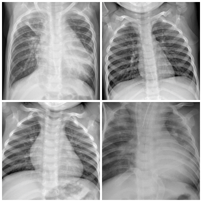 Chest XRay Pneumonia Thumbnail