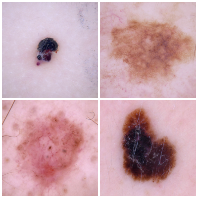 Skin Cancer Thumbnail